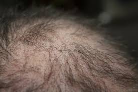 You are currently viewing Baldness in Women: Understanding Causes, Prevalence, Prevention, and Treatment